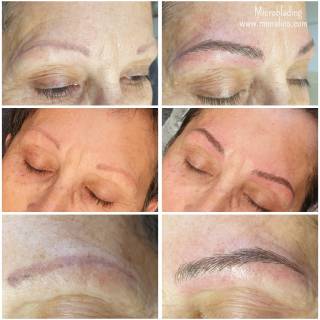 Microblading alopecia